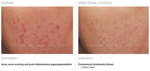 PCA SKIN acne acne scarring post inflammatory hyperpigmentation 2 e1512393858175 - PCA SKIN