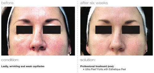 PCA SKIN laxity wrinkling weak capillaries 1 2 e1512393889194 - PCA SKIN